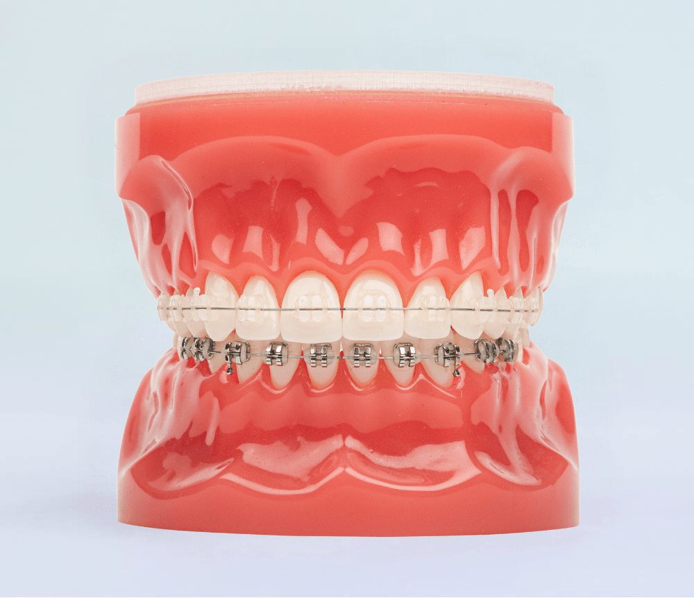 ceramic braces on plastic model